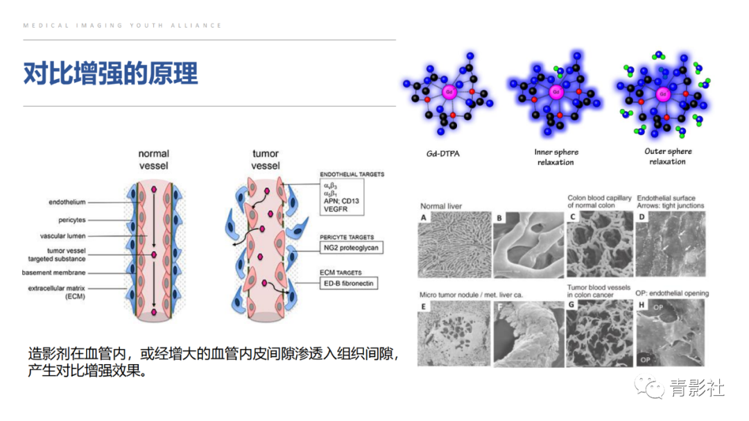影像PPT - 【PPT】肝环形强化样病变MRI诊断思路-5