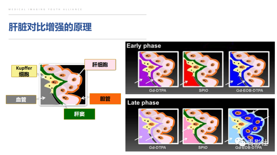 影像PPT - 【PPT】肝环形强化样病变MRI诊断思路-8