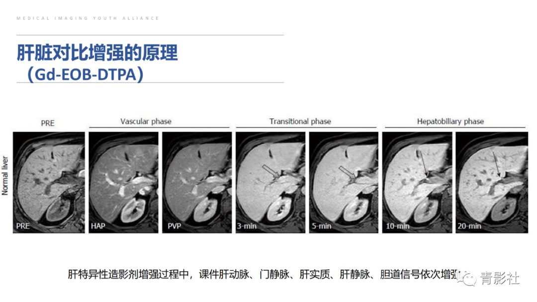 影像PPT - 【PPT】肝环形强化样病变MRI诊断思路-9