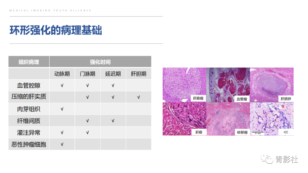 影像PPT - 【PPT】肝环形强化样病变MRI诊断思路-16