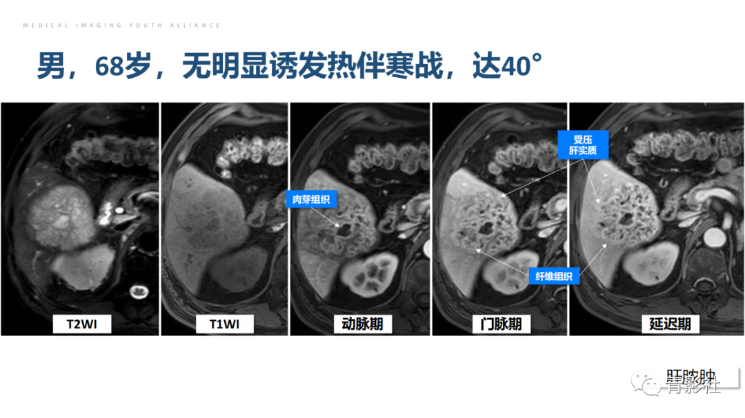 影像PPT - 【PPT】肝环形强化样病变MRI诊断思路-20