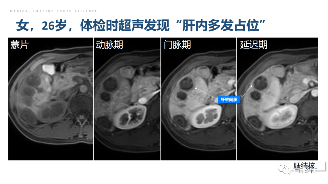 影像PPT - 【PPT】肝环形强化样病变MRI诊断思路-21