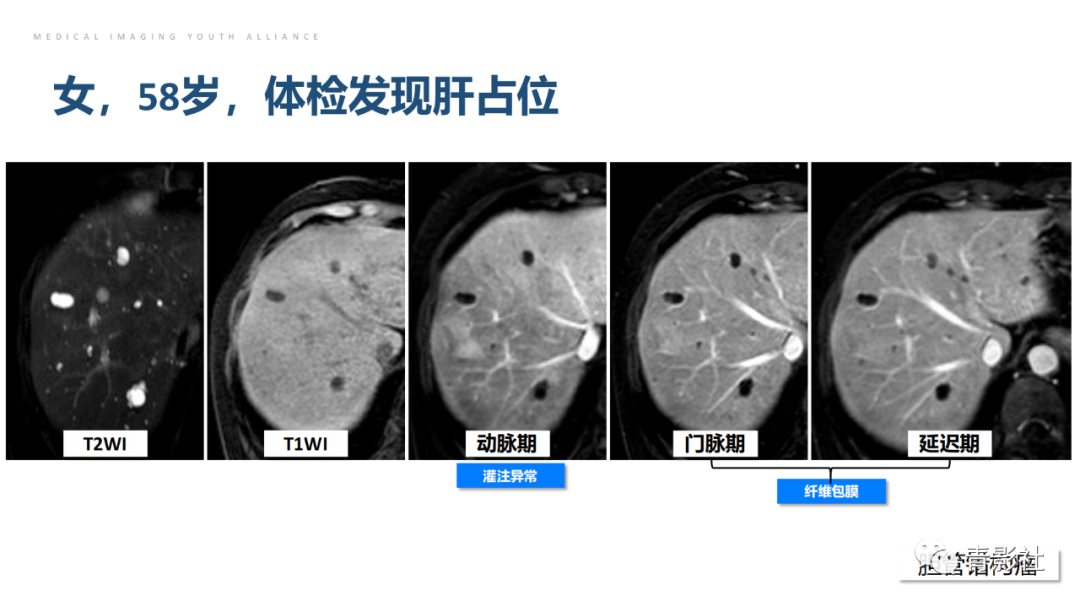 影像PPT - 【PPT】肝环形强化样病变MRI诊断思路-22