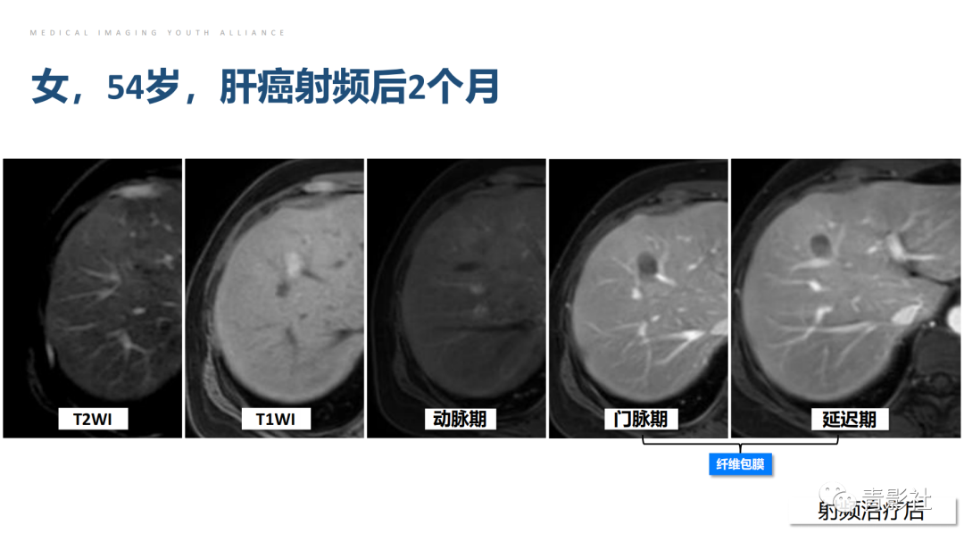 影像PPT - 【PPT】肝环形强化样病变MRI诊断思路-23