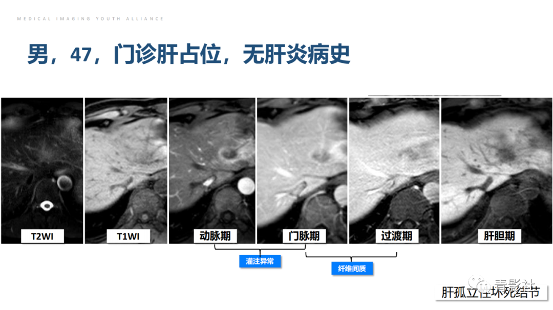 影像PPT - 【PPT】肝环形强化样病变MRI诊断思路-24