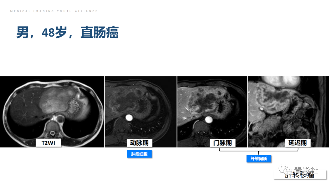影像PPT - 【PPT】肝环形强化样病变MRI诊断思路-27