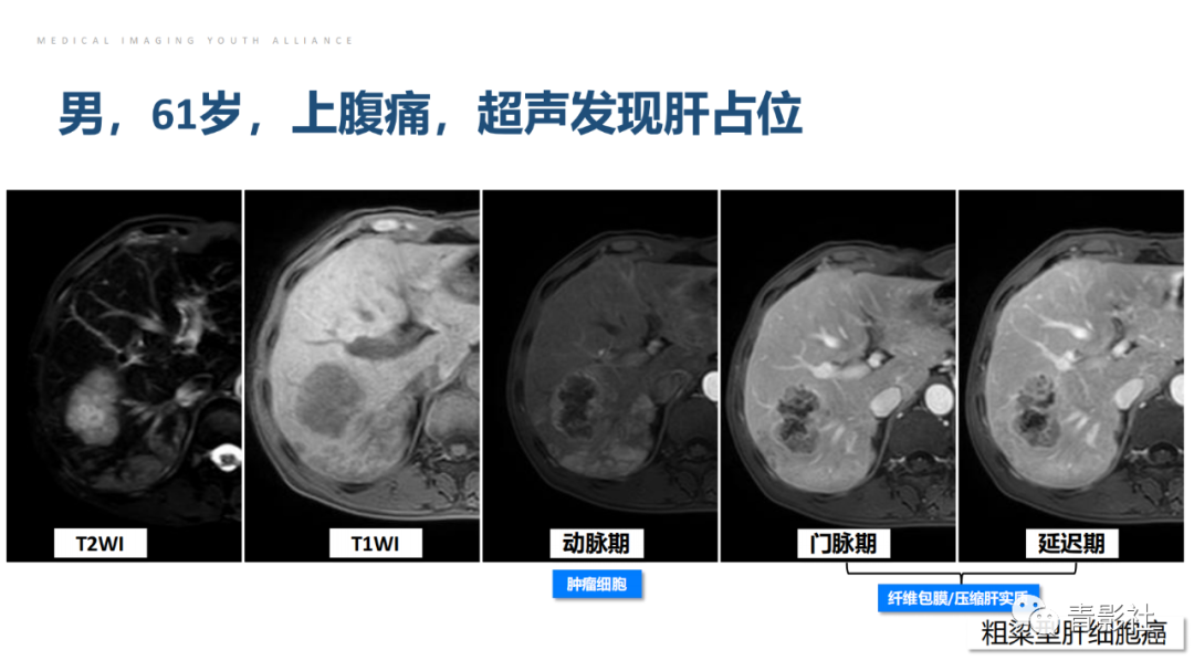 影像PPT - 【PPT】肝环形强化样病变MRI诊断思路-25
