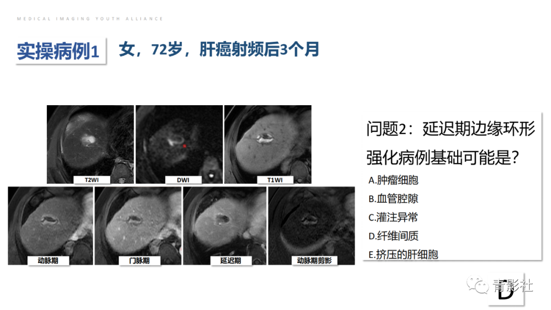 影像PPT - 【PPT】肝环形强化样病变MRI诊断思路-31