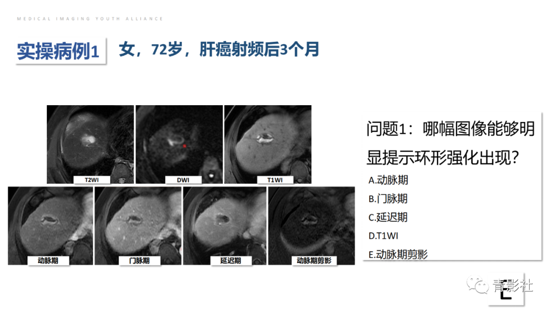 影像PPT - 【PPT】肝环形强化样病变MRI诊断思路-30