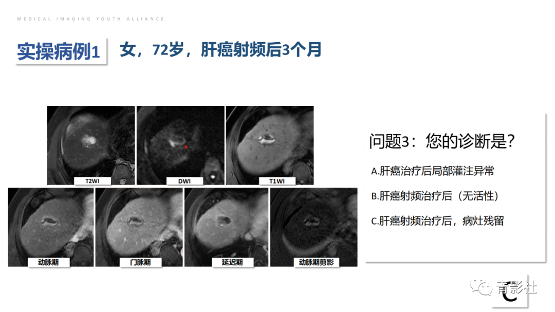 影像PPT - 【PPT】肝环形强化样病变MRI诊断思路-32