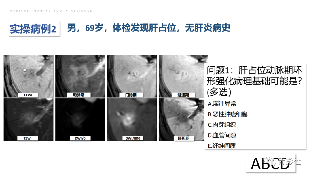 影像PPT - 【PPT】肝环形强化样病变MRI诊断思路-33