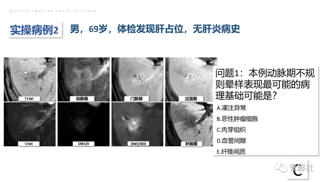 影像PPT - 【PPT】肝环形强化样病变MRI诊断思路-34