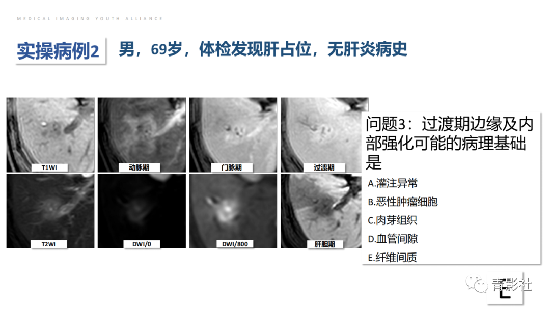 影像PPT - 【PPT】肝环形强化样病变MRI诊断思路-35