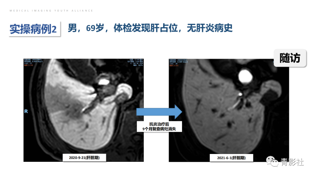 影像PPT - 【PPT】肝环形强化样病变MRI诊断思路-36