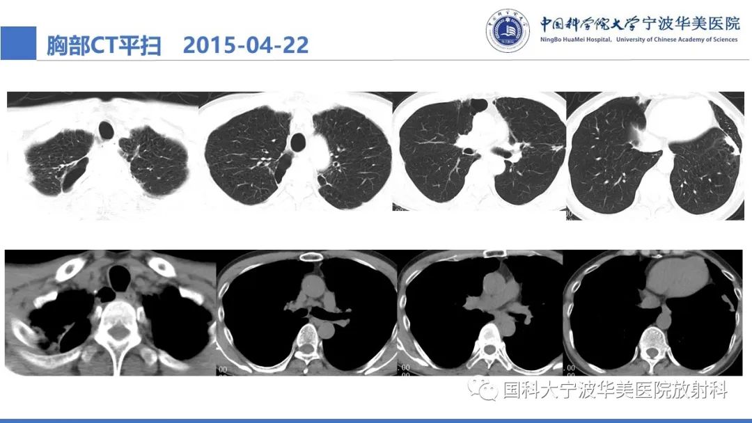 影像PPT - 【病例】抗中性粒细胞胞浆抗体相关性血管炎1例肺部CT表现-7