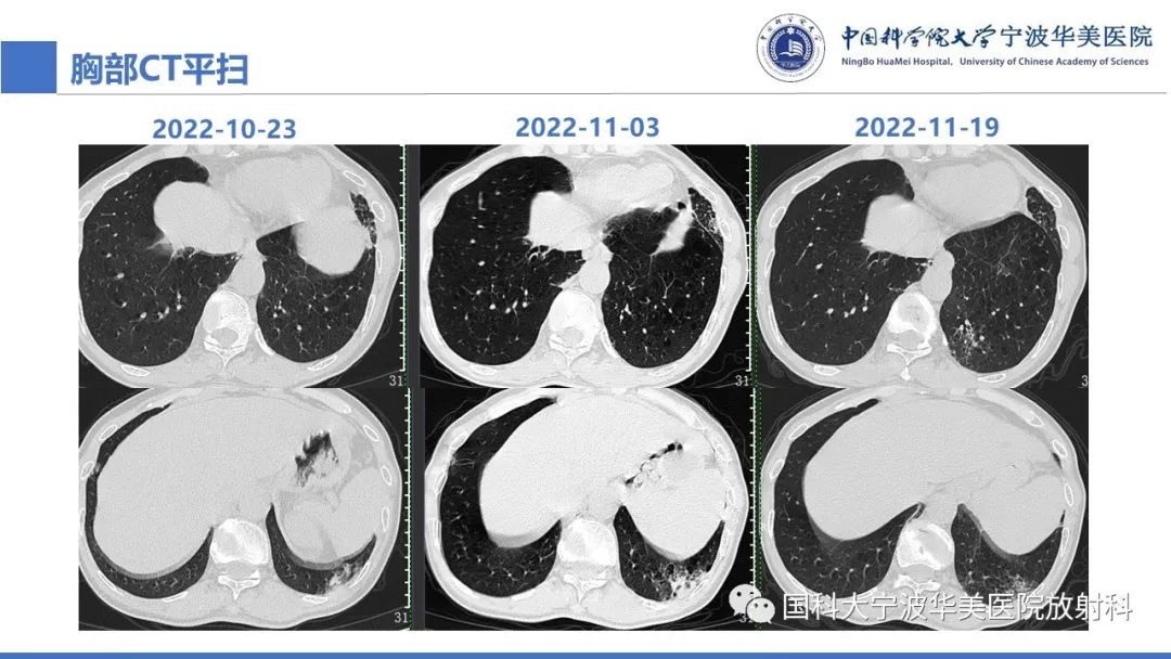 影像PPT - 【病例】抗中性粒细胞胞浆抗体相关性血管炎1例肺部CT表现-10