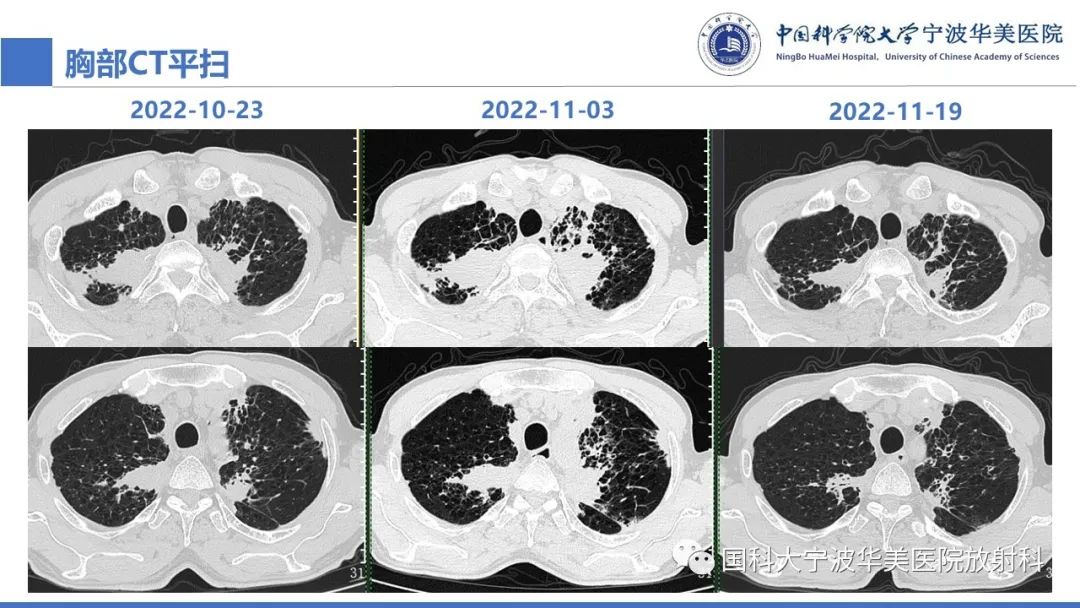 影像PPT - 【病例】抗中性粒细胞胞浆抗体相关性血管炎1例肺部CT表现-8