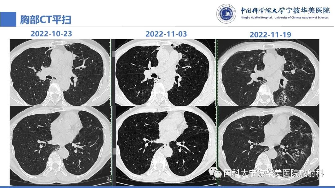 影像PPT - 【病例】抗中性粒细胞胞浆抗体相关性血管炎1例肺部CT表现-9