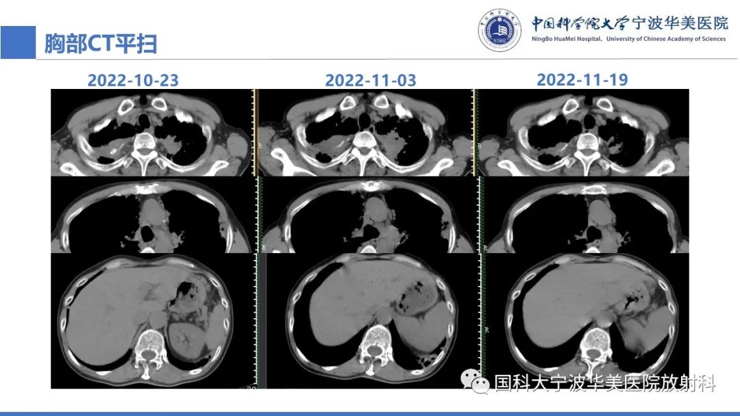 影像PPT - 【病例】抗中性粒细胞胞浆抗体相关性血管炎1例肺部CT表现-11