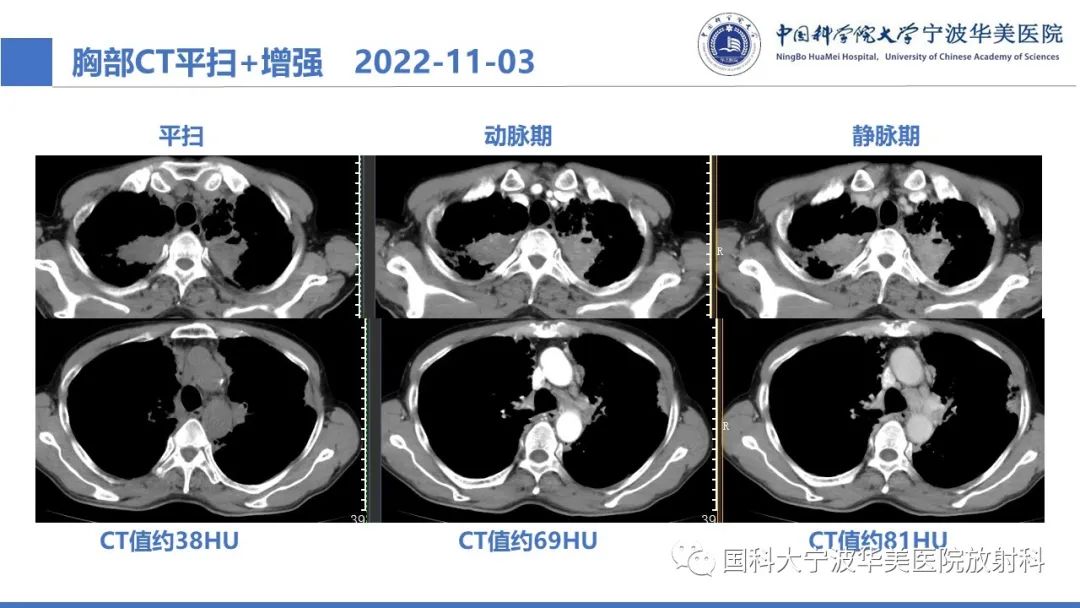 影像PPT - 【病例】抗中性粒细胞胞浆抗体相关性血管炎1例肺部CT表现-12