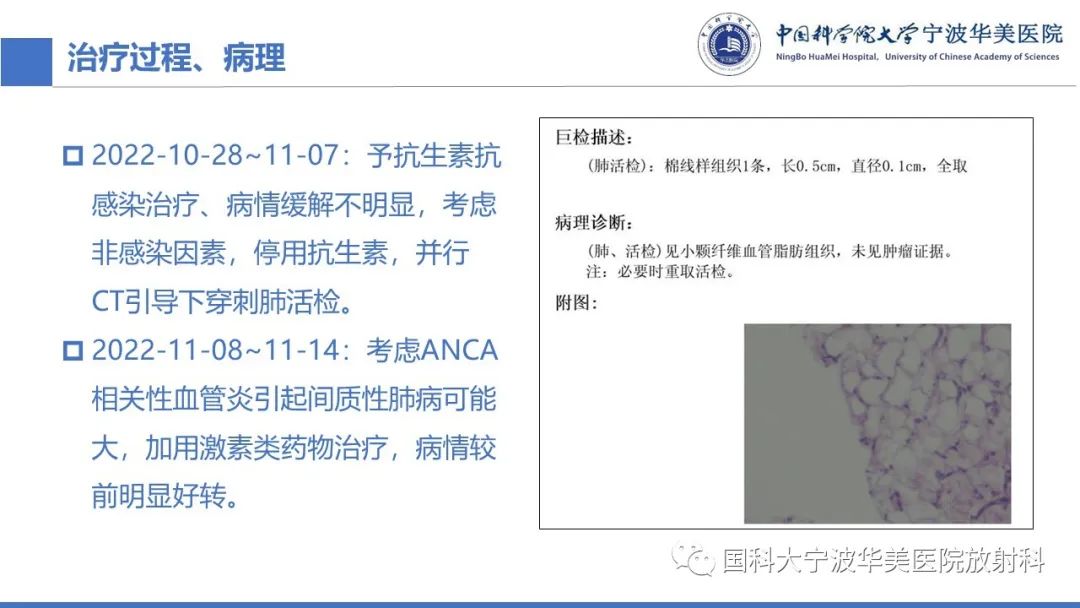影像PPT - 【病例】抗中性粒细胞胞浆抗体相关性血管炎1例肺部CT表现-14