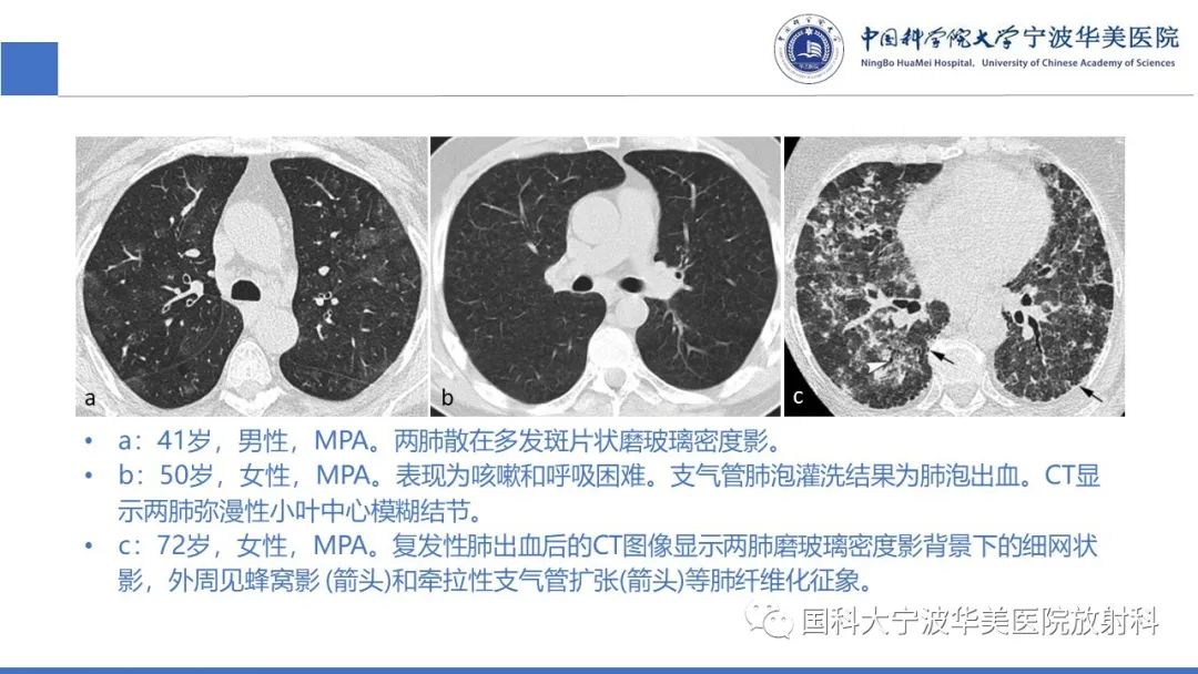 影像PPT - 【病例】抗中性粒细胞胞浆抗体相关性血管炎1例肺部CT表现-26