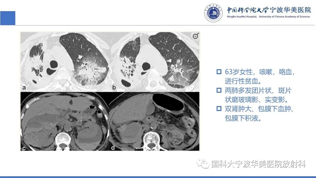 影像PPT - 【病例】抗中性粒细胞胞浆抗体相关性血管炎1例肺部CT表现-27
