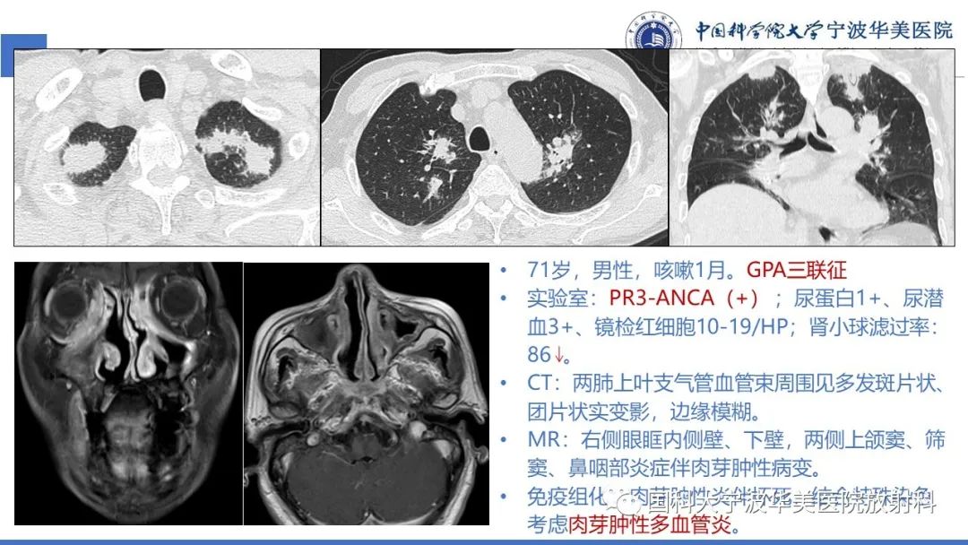 影像PPT - 【病例】抗中性粒细胞胞浆抗体相关性血管炎1例肺部CT表现-30