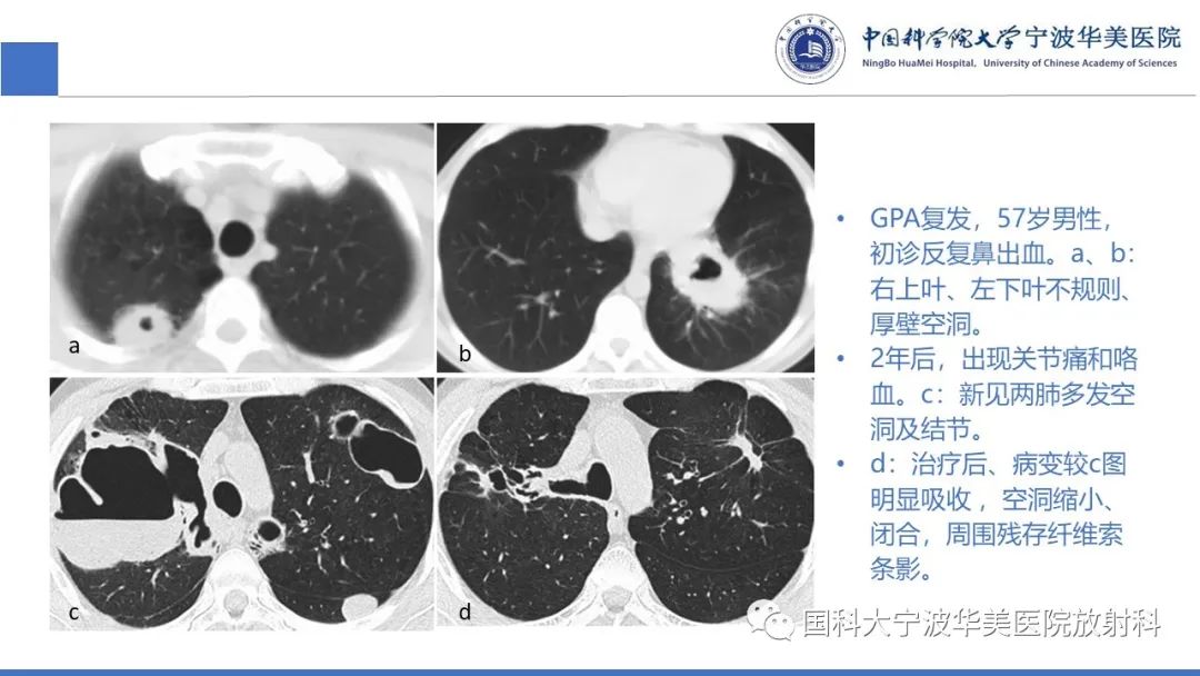 影像PPT - 【病例】抗中性粒细胞胞浆抗体相关性血管炎1例肺部CT表现-31
