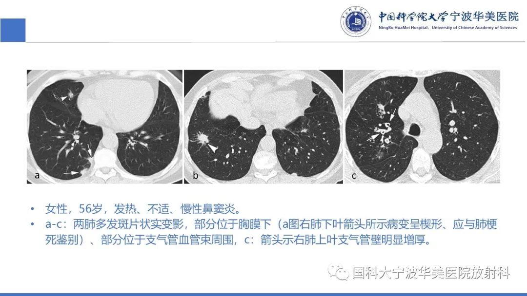影像PPT - 【病例】抗中性粒细胞胞浆抗体相关性血管炎1例肺部CT表现-32