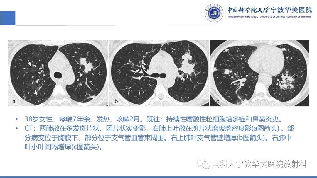 影像PPT - 【病例】抗中性粒细胞胞浆抗体相关性血管炎1例肺部CT表现-35