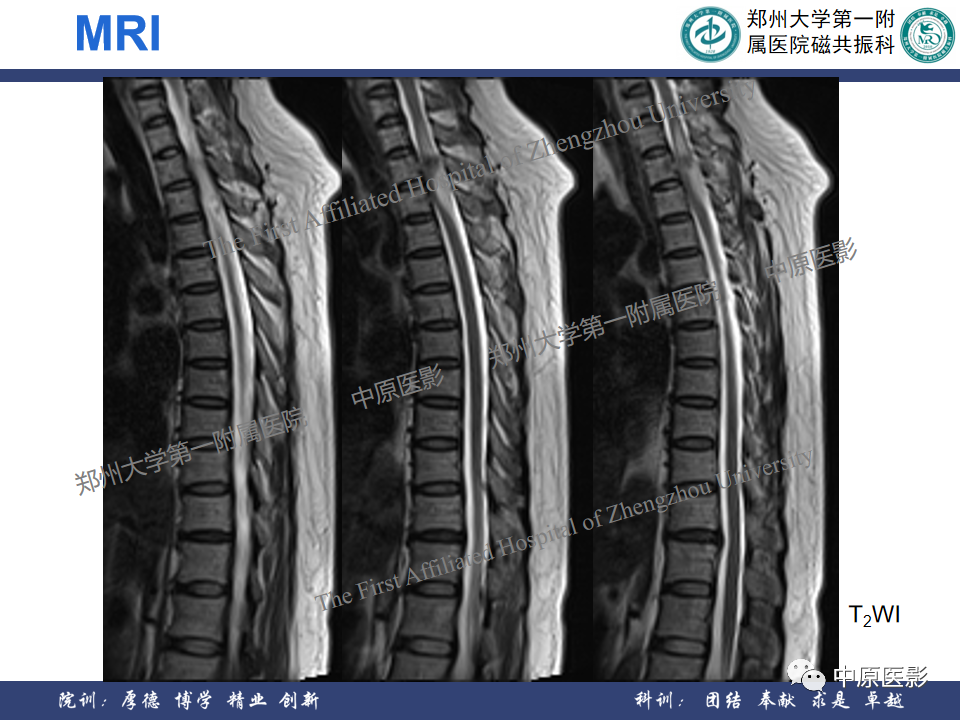 影像PPT - 【病例】椎管孤立性纤维性肿瘤1例MR影像-3