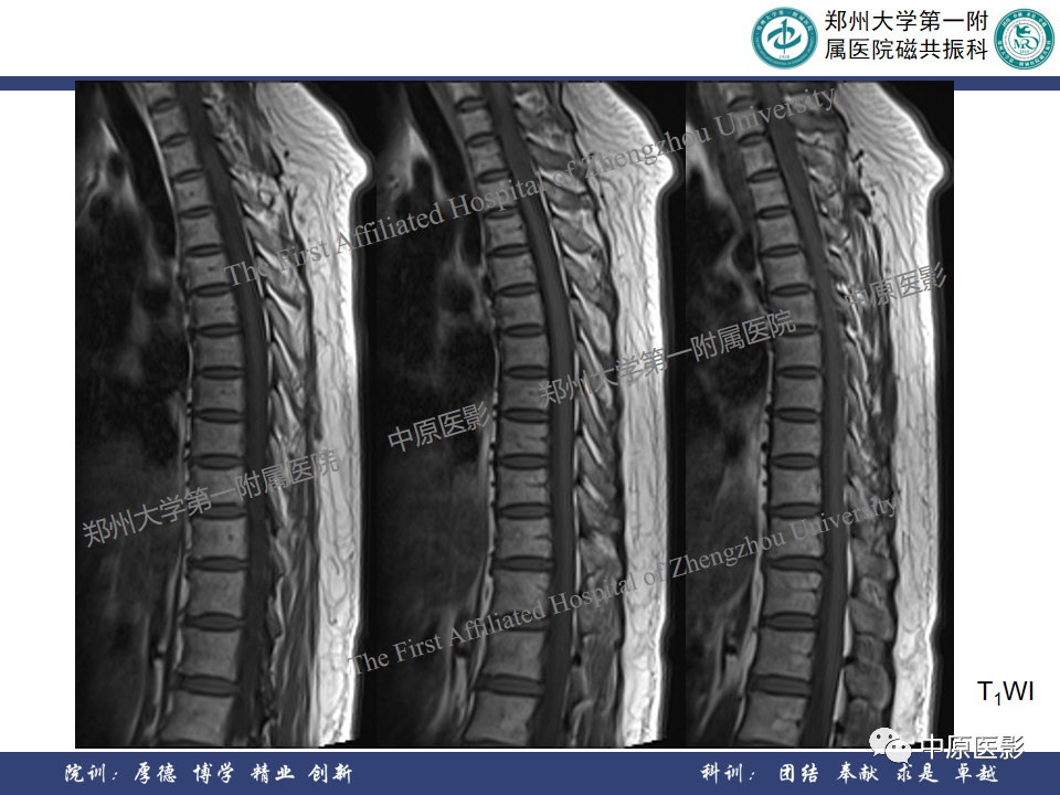 影像PPT - 【病例】椎管孤立性纤维性肿瘤1例MR影像-4