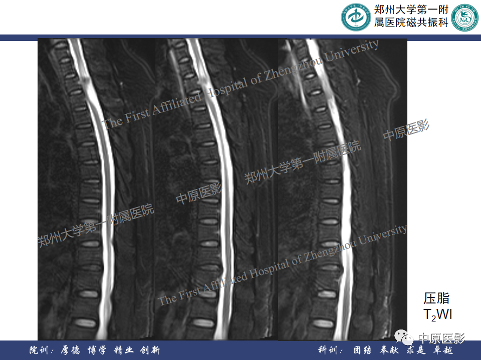 影像PPT - 【病例】椎管孤立性纤维性肿瘤1例MR影像-5