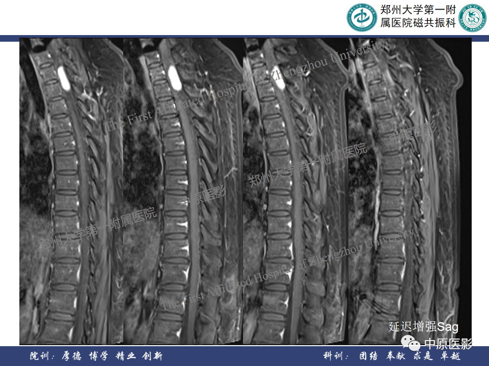 影像PPT - 【病例】椎管孤立性纤维性肿瘤1例MR影像-7