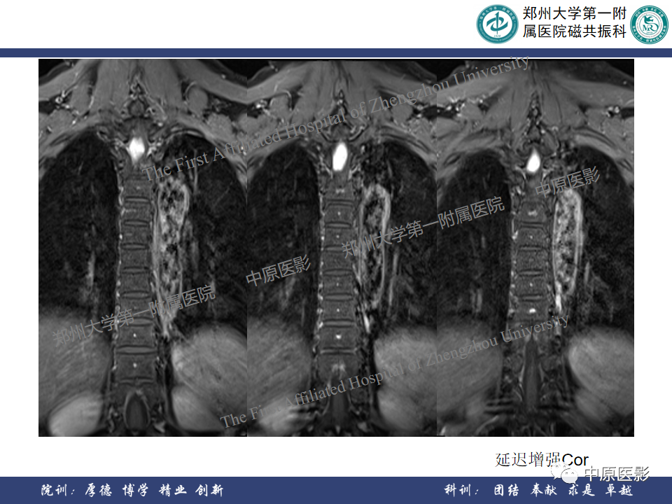 影像PPT - 【病例】椎管孤立性纤维性肿瘤1例MR影像-8