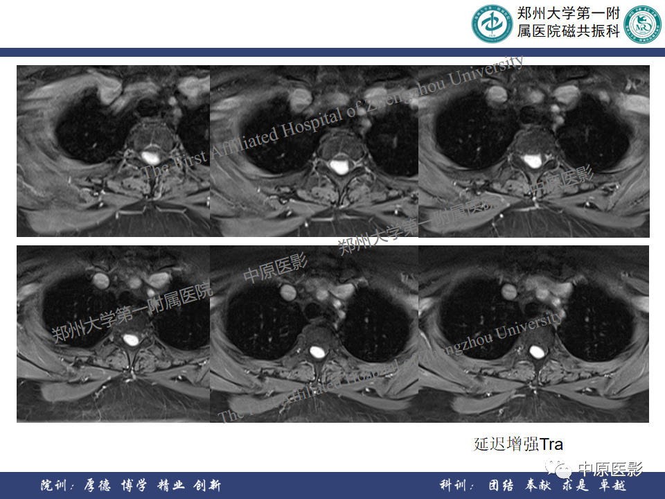 影像PPT - 【病例】椎管孤立性纤维性肿瘤1例MR影像-9