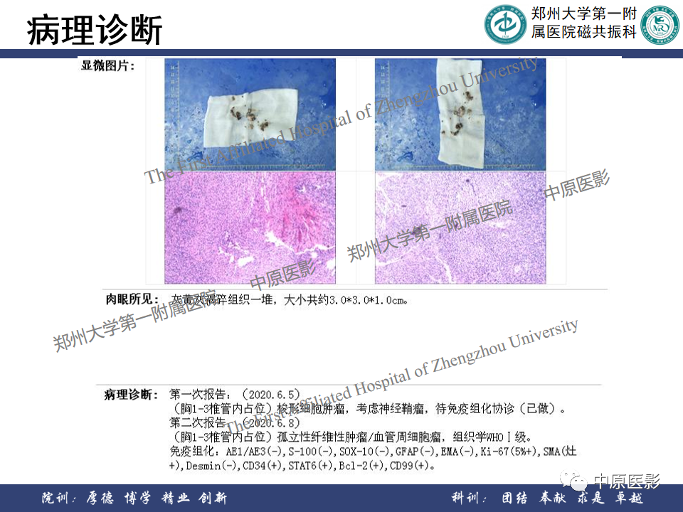 影像PPT - 【病例】椎管孤立性纤维性肿瘤1例MR影像-12