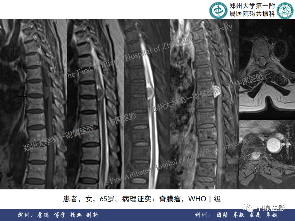 影像PPT - 【病例】椎管孤立性纤维性肿瘤1例MR影像-18