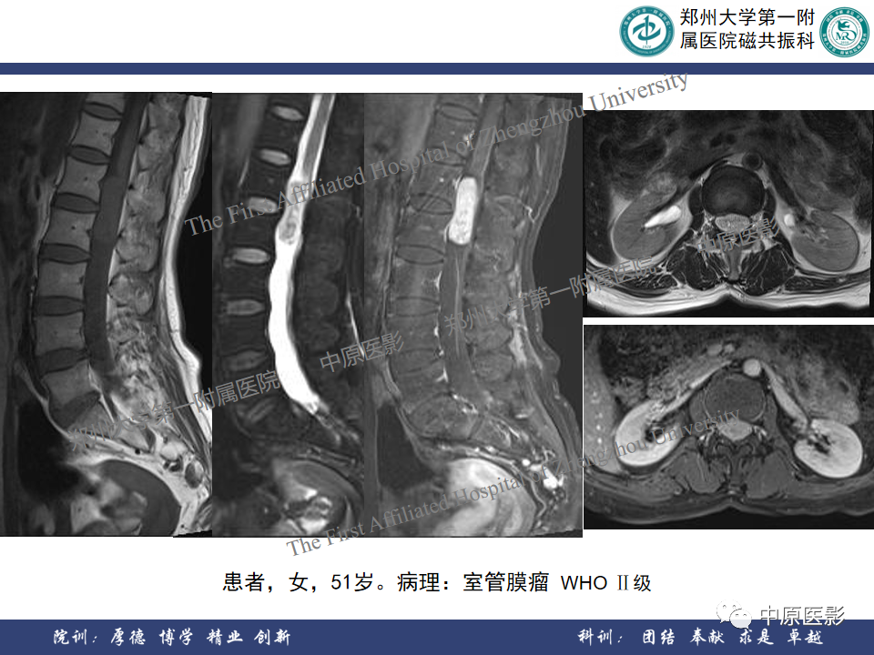 影像PPT - 【病例】椎管孤立性纤维性肿瘤1例MR影像-22