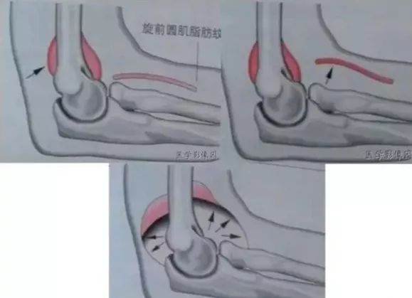 影像PPT - 八字征与关节腔积液-2 影像PPT - 八字征与关节腔积液-2