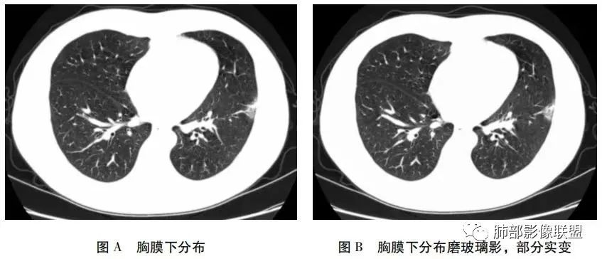 影像PPT - 新冠肺炎分布特征及影像综合分析-5 影像PPT - 新冠肺炎分布特征及影像综合分析-5