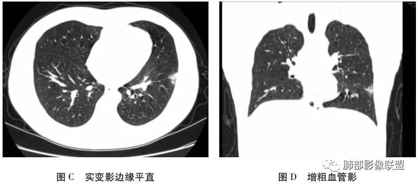 影像PPT - 新冠肺炎分布特征及影像综合分析-6 影像PPT - 新冠肺炎分布特征及影像综合分析-6