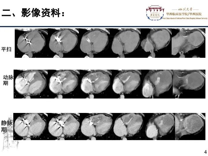 影像PPT - 【病例】心脏内膜肉瘤1例CT影像诊断-4
