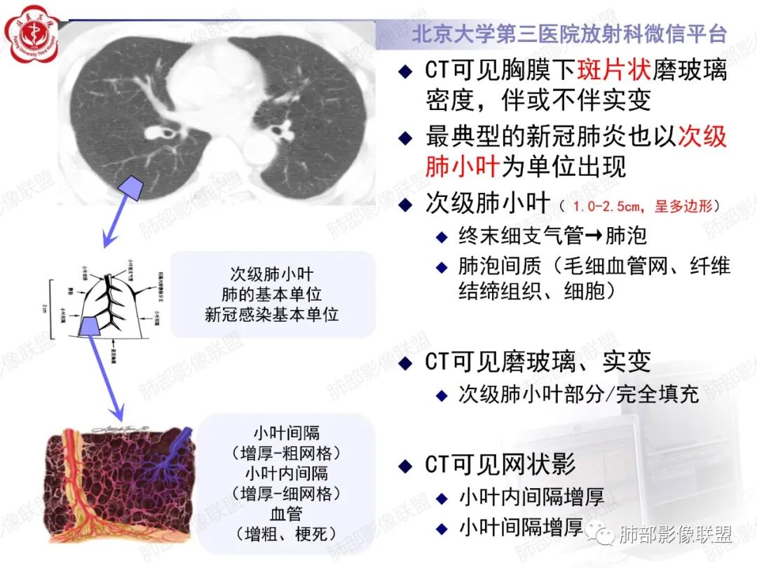 影像PPT - 【PPT】新冠肺炎CT影像表现-7