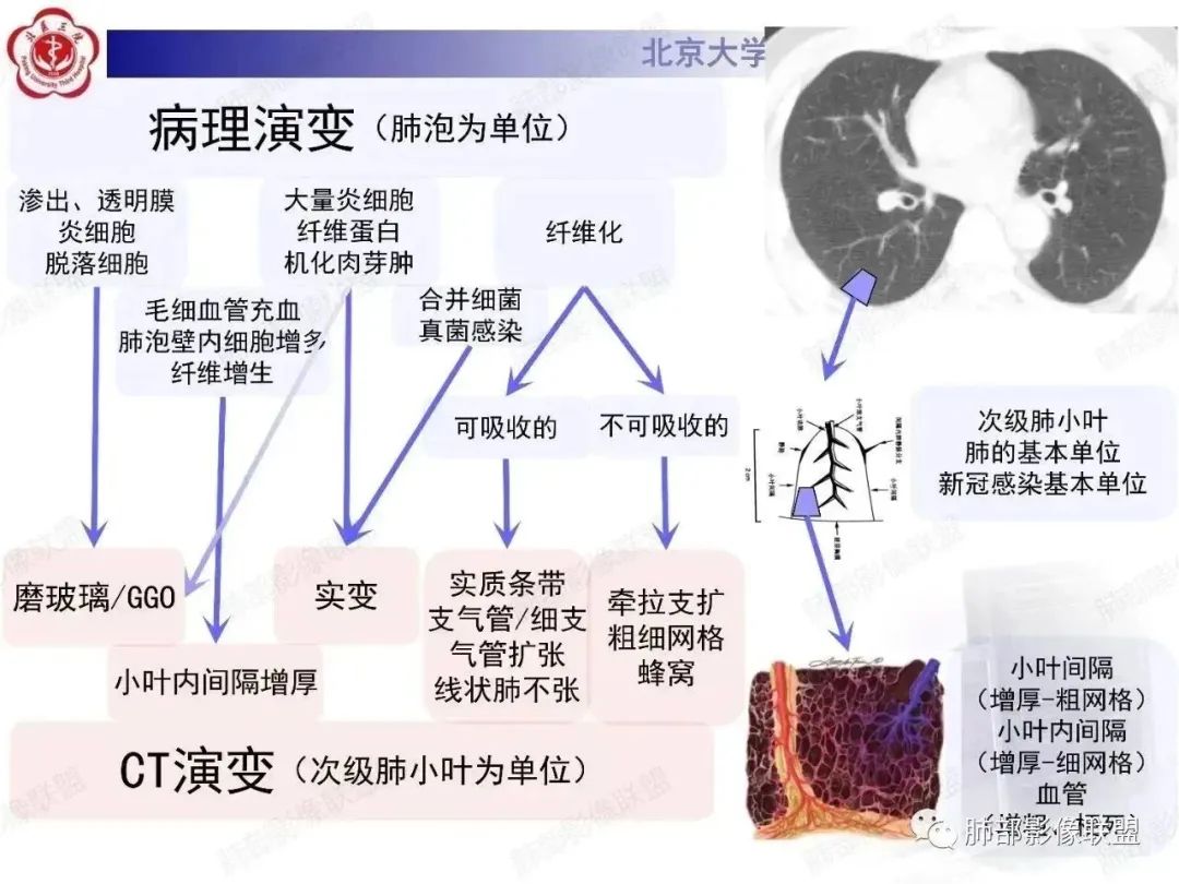 影像PPT - 【PPT】新冠肺炎CT影像表现-8