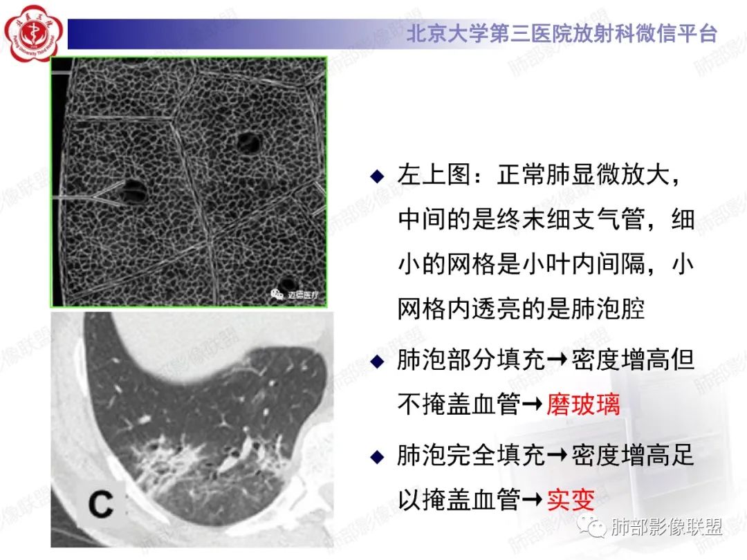 影像PPT - 【PPT】新冠肺炎CT影像表现-9