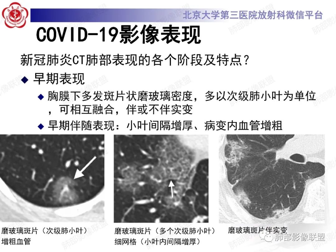 影像PPT - 【PPT】新冠肺炎CT影像表现-12