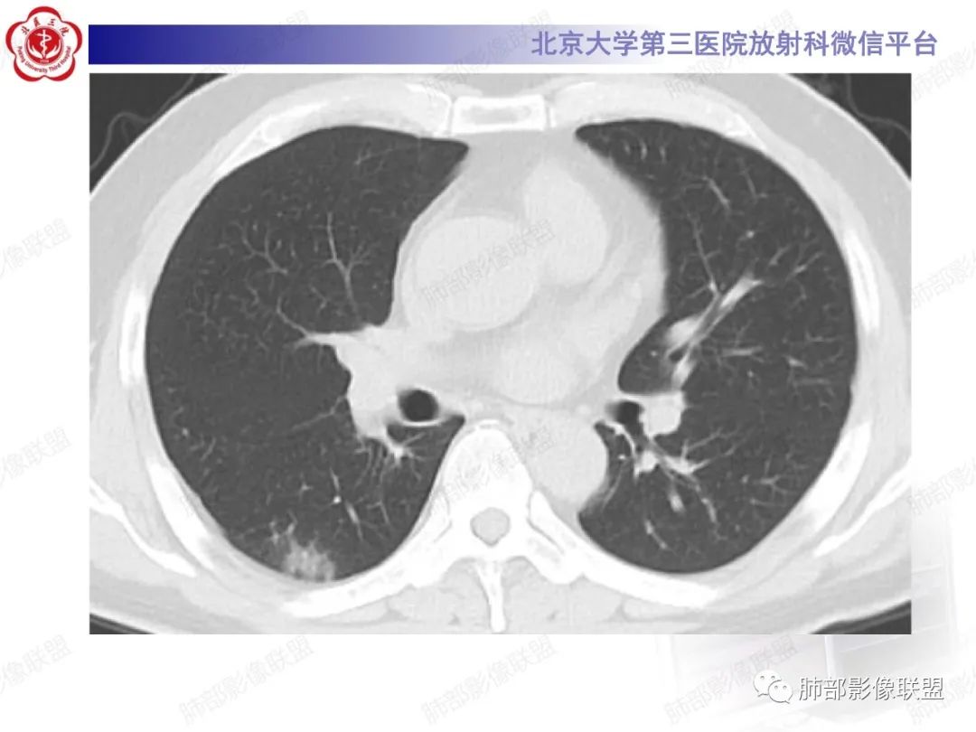 影像PPT - 【PPT】新冠肺炎CT影像表现-13