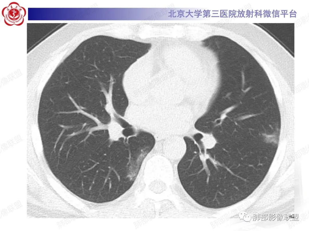 影像PPT - 【PPT】新冠肺炎CT影像表现-14